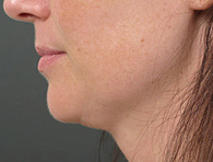 After Ultherapy skin tightening - San Diego Dermatology and Laser Surgery